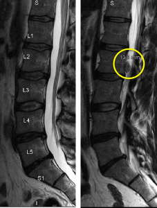 L2-3: Mild facet and ligamentous hypertrophy. Minimal circumferential annular bulge mild central canal narrowing. No foraminal stenosis. Superior extending right extruded herniation in the right gutter extending posterior to the L2 vertebral body, 13 mm craniocaudal.